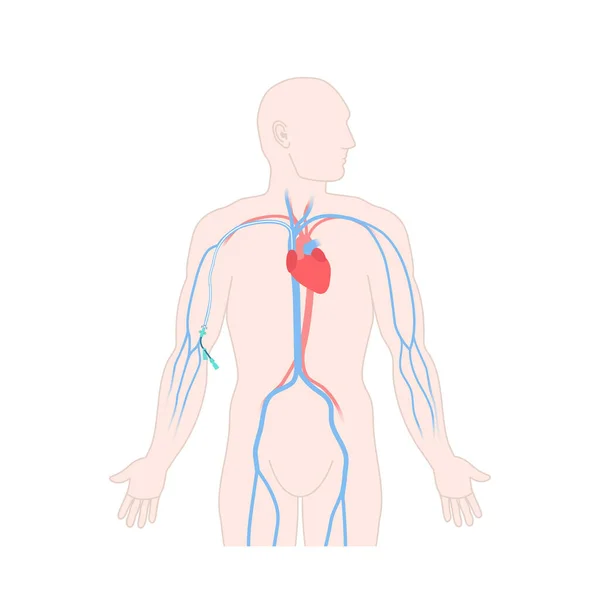 上腕静脈に置かれた周期的に挿入された中央カテーテル 薬や栄養液の配信のためのPiccチューブを持つ男性患者 ヘルスケアの概念 医用ベクターイラスト — ストックベクタ