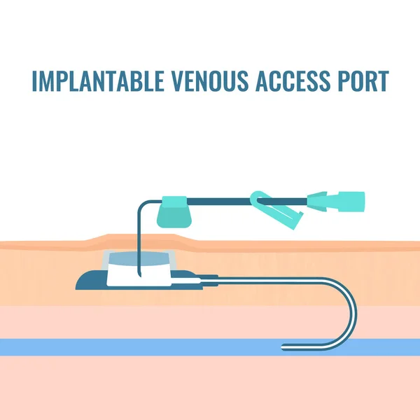 Implantable Venous Access Port Cross Section Skin Central Line Access — Stock Vector