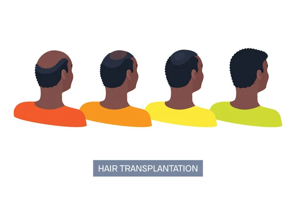 Afro hårtransplantation kirurgi hos män infographics — Stock vektor