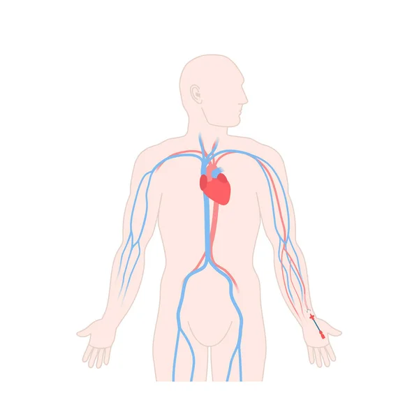 男性の手首に放射状動脈に配置動脈線カテーテル 動脈血中ガス分析と監視圧力のための重要なケアアートライン 医用ベクターイラスト — ストックベクタ