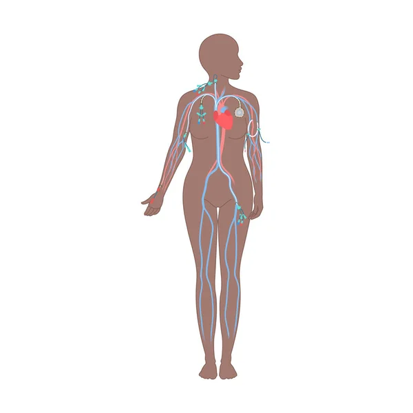 女性の体に示されている中央静脈カテーテル配置部位 中央線の種類 Cvcアクセスデバイスを持つ女性 Picc 動脈ライン 注入のための埋め込みポート 医用ベクターイラスト — ストックベクタ