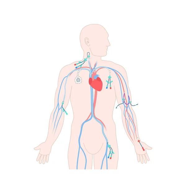 Los Sitios Colocación Del Catéter Venoso Central Muestran Cuerpo Masculino — Vector de stock