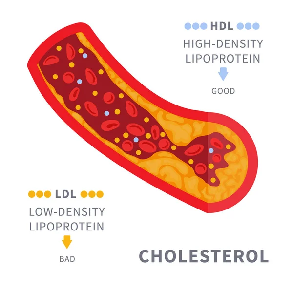 Narrowed Blood Vessel Cholesterol Plaque Buildup Artery Blocked Fat Cells — Stock Vector
