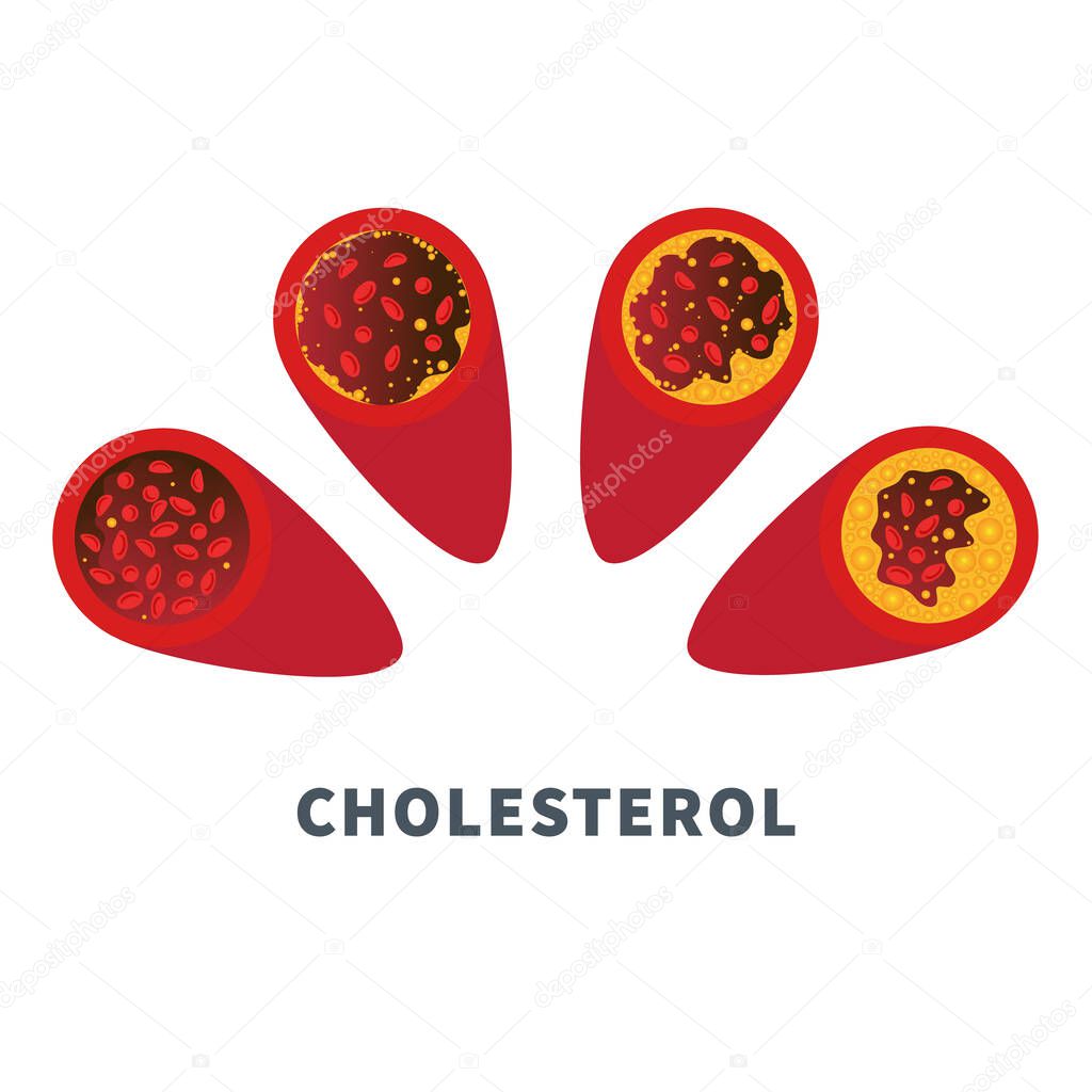 Cholesterol level on blocked blood vessel medical diagram. Atherosclerosis risk scale. Meter gauge of ldl and hdl lipoprotein. High and low fat test indicator. Healthcare concept. Vector illustration.