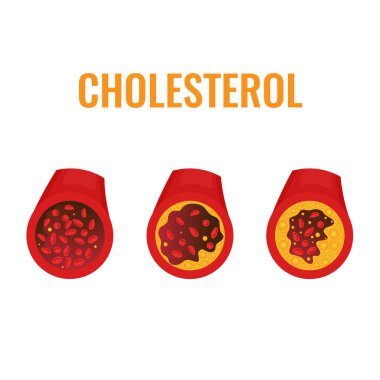 Cholesterol plaque in blocked blood vessel medical diagram. ldl and hdl lipoprotein in artery. Atherosclerosis stages and thrombus risk test indicator. Healthcare concept. Vector illustration.
