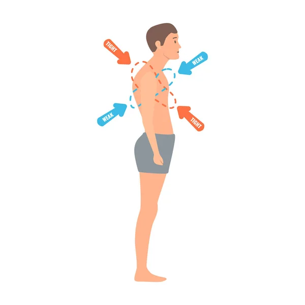 Syndrome Croisé Supérieur Diagramme Médical Homme Tordu Avec Déséquilibre Musculaire — Image vectorielle