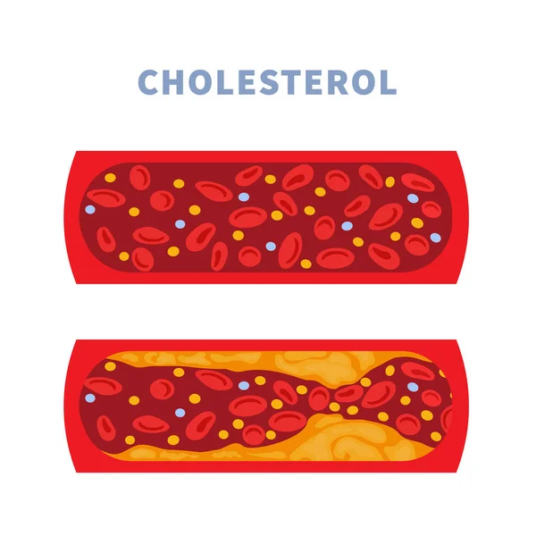 Normale Bloedvat Slagader Met Cholesterolplaque Opbouw Vernauwde Bloedader Geblokkeerd Door — Stockvector