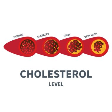 Different stages of cholesterol plaque buildup in artery. Low to high fat count in blood vessel diagram. Meter gauge of ldl and hdl lipoprotein. Atherosclerosis risk indicator. Vector illustration.
