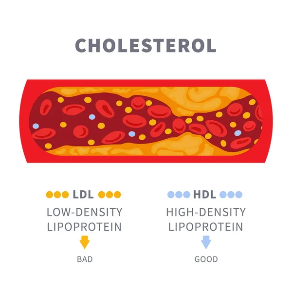 Narrowed Blood Vessel Cholesterol Plaque Buildup Artery Blocked Fat Cells — Stockvector