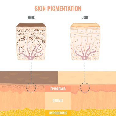 Comparison of melanosomes distribution in dark and light skin. Pigmentation mechanism in different skin phototypes infographics. Close up of epidermis cross-section. Vector medical illustration.