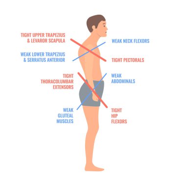 Upper and lower crossed syndrome medical diagram. Crooked man with muscle strength imbalance. Weak and overactive muscles therapy. Incorrect spine curvature caused by bad posture. Vector illustration. clipart