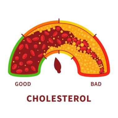 Cholesterol level on blocked blood vessel medical diagram. Meter gauge of bad hdl lipoprotein. High and low fat test indicator. Atherosclerosis risk. Healthcare concept. Vector illustration.