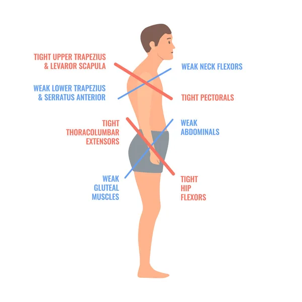 Diagrama Médico Del Síndrome Cruzado Superior Inferior Hombre Torcido Con — Vector de stock