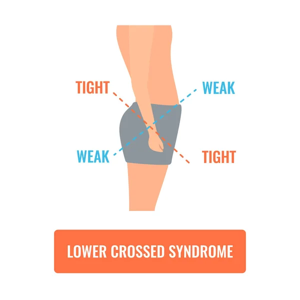 Sindrome Attraversata Inferiore Diagramma Medico Uomo Storto Con Squilibrio Muscolare — Vettoriale Stock