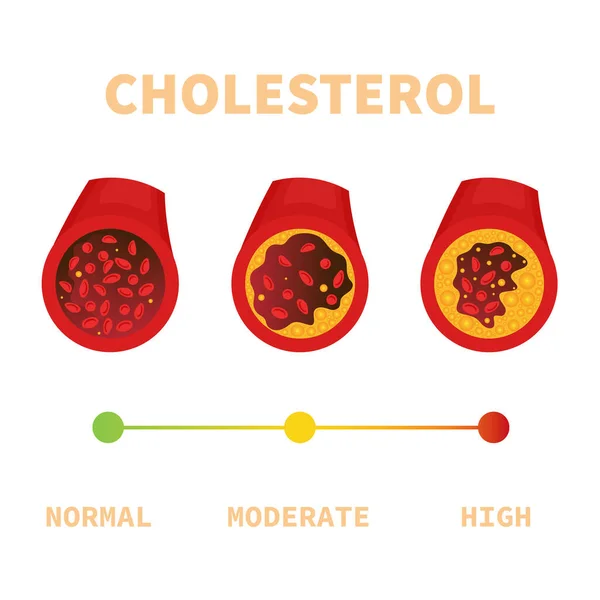 Placca Colesterolo Nel Diagramma Medico Dei Vasi Sanguigni Ostruito Ldl — Vettoriale Stock