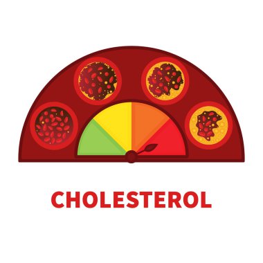 Cholesterol level on blocked blood vessel medical diagram. Atherosclerosis risk scale. Meter gauge of ldl and hdl lipoprotein. High and low fat test indicator. Healthcare concept. Vector illustration.