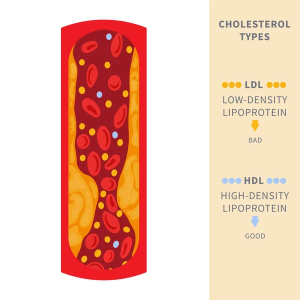 Narrowed Blood Vessel Cholesterol Plaque Buildup Artery Blocked Fat Cells — Stockvector