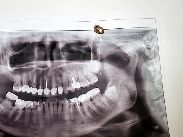Fotografia Mesa Dentista Coroa Metálico Cerâmica Paciente Repousa Sobre Ele — Fotografia de Stock