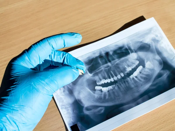 Dentista Examina Mostra Coroa Paciente Fundo Está Uma Foto Mãos — Fotografia de Stock