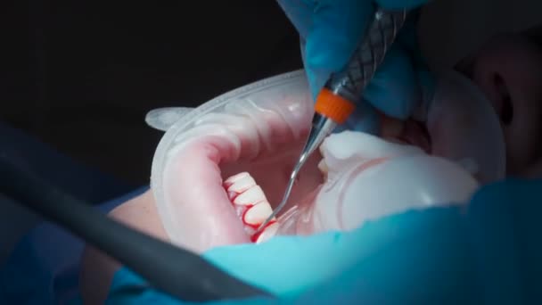 Treatment Teeth Stomatology High Quality Footage — Stok video