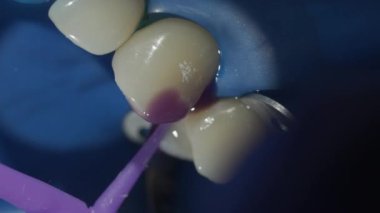 Dişin dolum için hazırlanması. Makro. Yüksek kalite 4k görüntü
