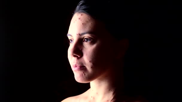 Vrouw gezicht bedekt met rode acne waterpokken ziekte — Stockvideo