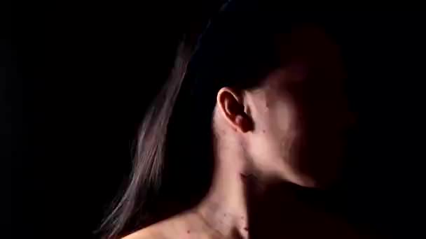 Vrouw gezicht bedekt met rode acne waterpokken ziekte — Stockvideo