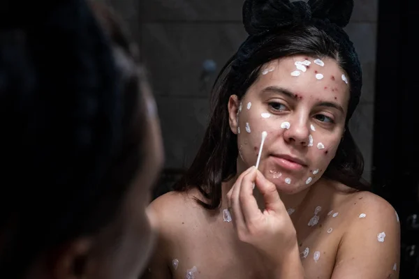 Adulto Mulher Retrato Varicela Doença Reflexão Banheiro Espelho — Fotografia de Stock