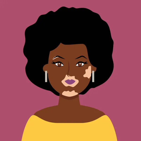 Retrato Uma Mulher Africana Com Vitiligo Doença Despigmentação Ilustração Vetorial —  Vetores de Stock