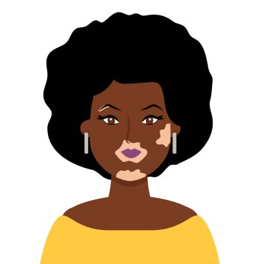 Vitiligo 'su olan Afrikalı bir kadının portresi, çizgi film tarzında Dağıtım Hastalığı Vektörü çizimi