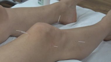 Dizinde akapunktur, dizinde iyileşme için osteoartrit tedavisi.