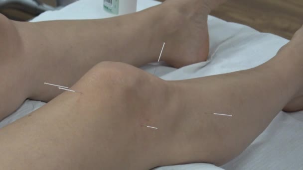 Akupunktur Knie Arthrosebehandlung Knie Zur Rehabilitation — Stockvideo