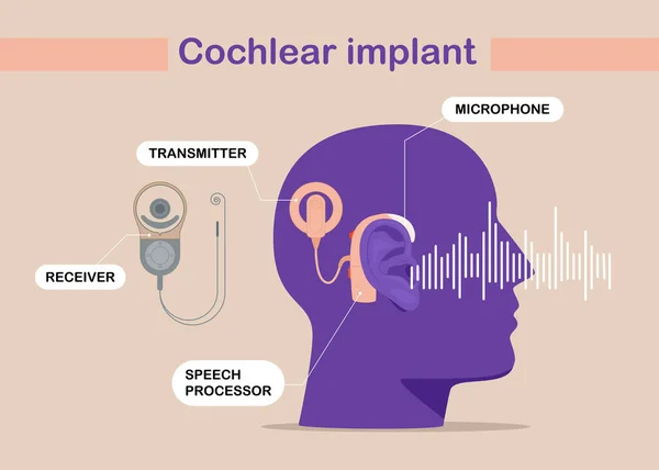  Koklear implant cihazı, sinirsel tıbbi yardım kulaklığını uyarıyor. Yetişkinleri muayene ediyor. Düz vektör illüstrasyonu.