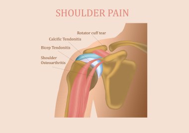 Shoulder joint structure and shoulder tendonitis. The collage of man with shoulder pain. Healthcare concept clipart