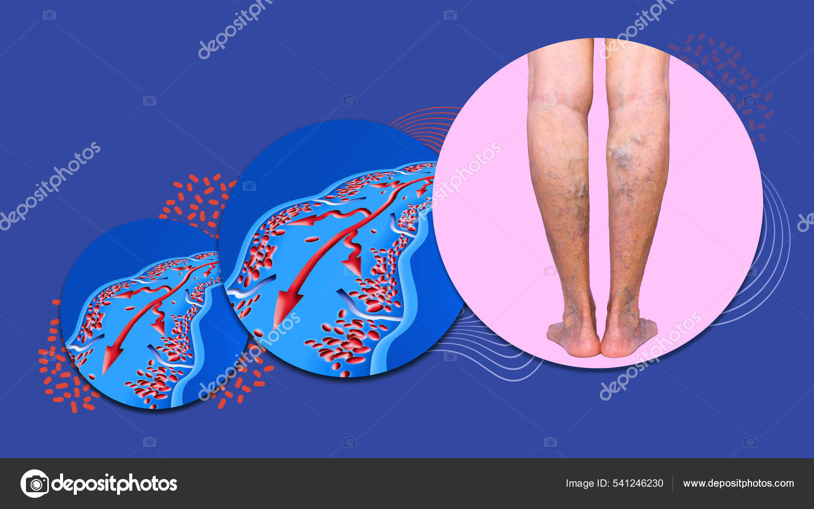 Varicose Veins Female Senior Legs Structure Normal Varicose Veins