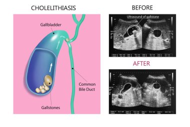 Ultrasonography image of gallbladder with gall stones at upper abdomen. Gallstones concept - anatomy of cholelithiasis
