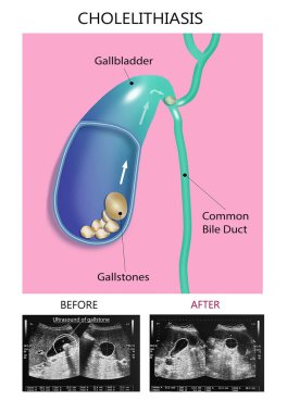Ultrasonography image of gallbladder with gall stones at upper abdomen. Gallstones concept - anatomy of cholelithiasis
