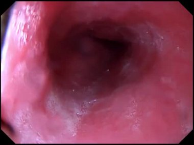 Gastroscopy examination of the gullet and stomach