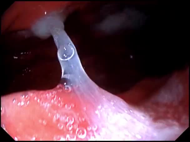 Gastroscopy Examination Gullet Stomach — Video Stock