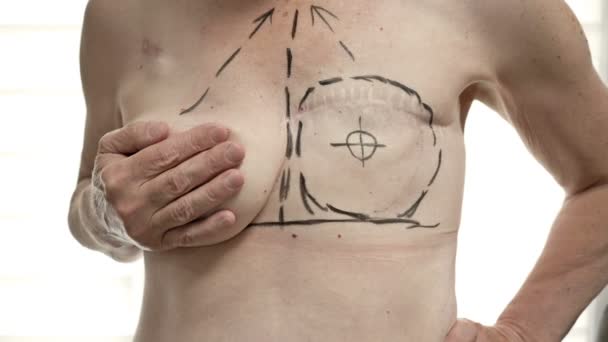 Preparazione per la ricostruzione del seno per una donna sottoposta a mastectomia. Chirurgia plastica del seno dopo mastectomia. — Video Stock