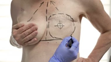 Göğüs ameliyatına hazırlanan bir kadın için mastektomi. Göğüs estetiği ameliyatından sonra mastektomi.