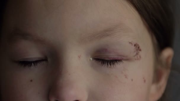 Close-up de uma ferida dolorosa perto do olho de uma menina de 6-7 anos. — Vídeo de Stock