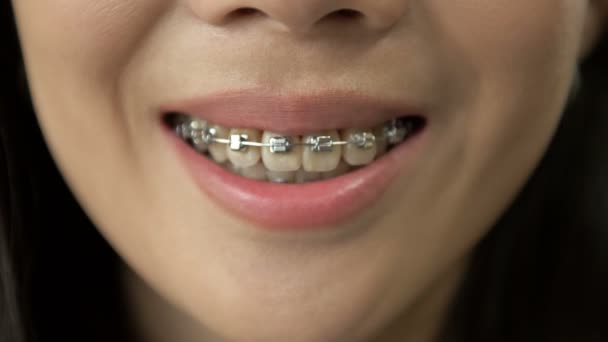美丽的白色牙齿 带着大括号 美丽的女人 带着假牙配件 正畸治疗 用健康的女性嘴捂住 — 图库视频影像