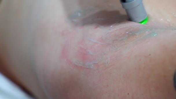 Cerrar hombre depilación axila láser depilación tratamiento procedimiento de depilación — Vídeo de stock