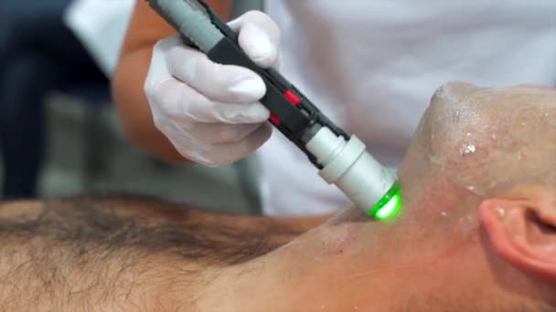 Close up man face depilation laser hair removal procedure treatment — Stock Video