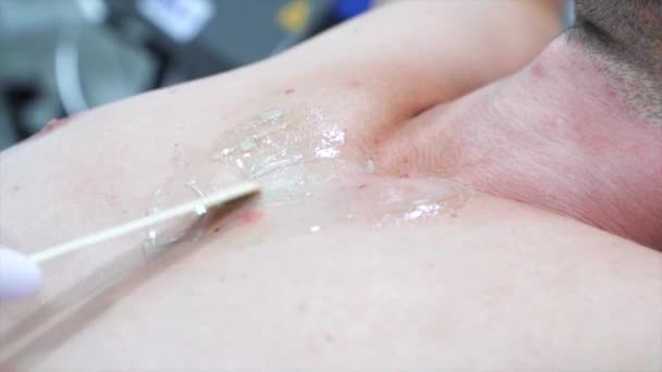 El médico-cosmetólogo con guantes especiales coloca el gel en el cuerpo de los pacientes — Vídeo de stock