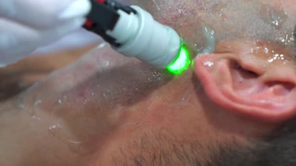 Close up uomo viso depilazione laser trattamento procedura di depilazione — Video Stock