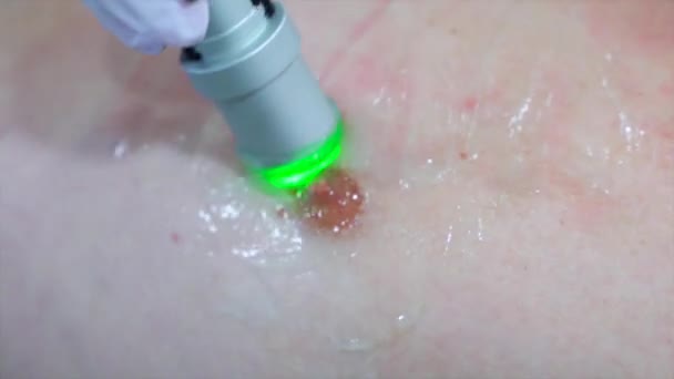 Close up nipple depilation laser hair removal procedure treatment — Stock Video