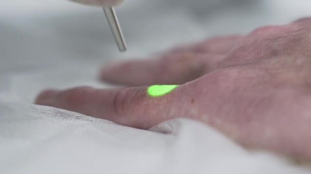 Extremo primer plano de lazerepilation en el brazo del hombre. El médico elimina el cabello no deseado del paciente con un equipo de depilación perezoso — Vídeos de Stock