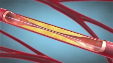 Stent implantation for supporting blood circulation into blood vessels during angioplasty - 3d illustration